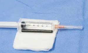 Phẫu thuật rút chiếc đũa đâm xuyên mắt người đàn ông Phẫu thuật rút chiếc đũa đâm xuyên mắt người đàn ông